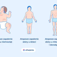 Ilustracja pokazuje, jak atopowe zapalenie skóry objawia się u niemowląt, dzieci i dorosłych, ukazując zmiany skórne na różnych etapach życia.