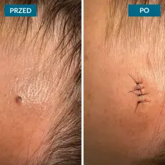 Przed i po zabiegu: znamię na czole przed i po usunięciu chirurgicznym. Terapia laserowa może być alternatywą.
