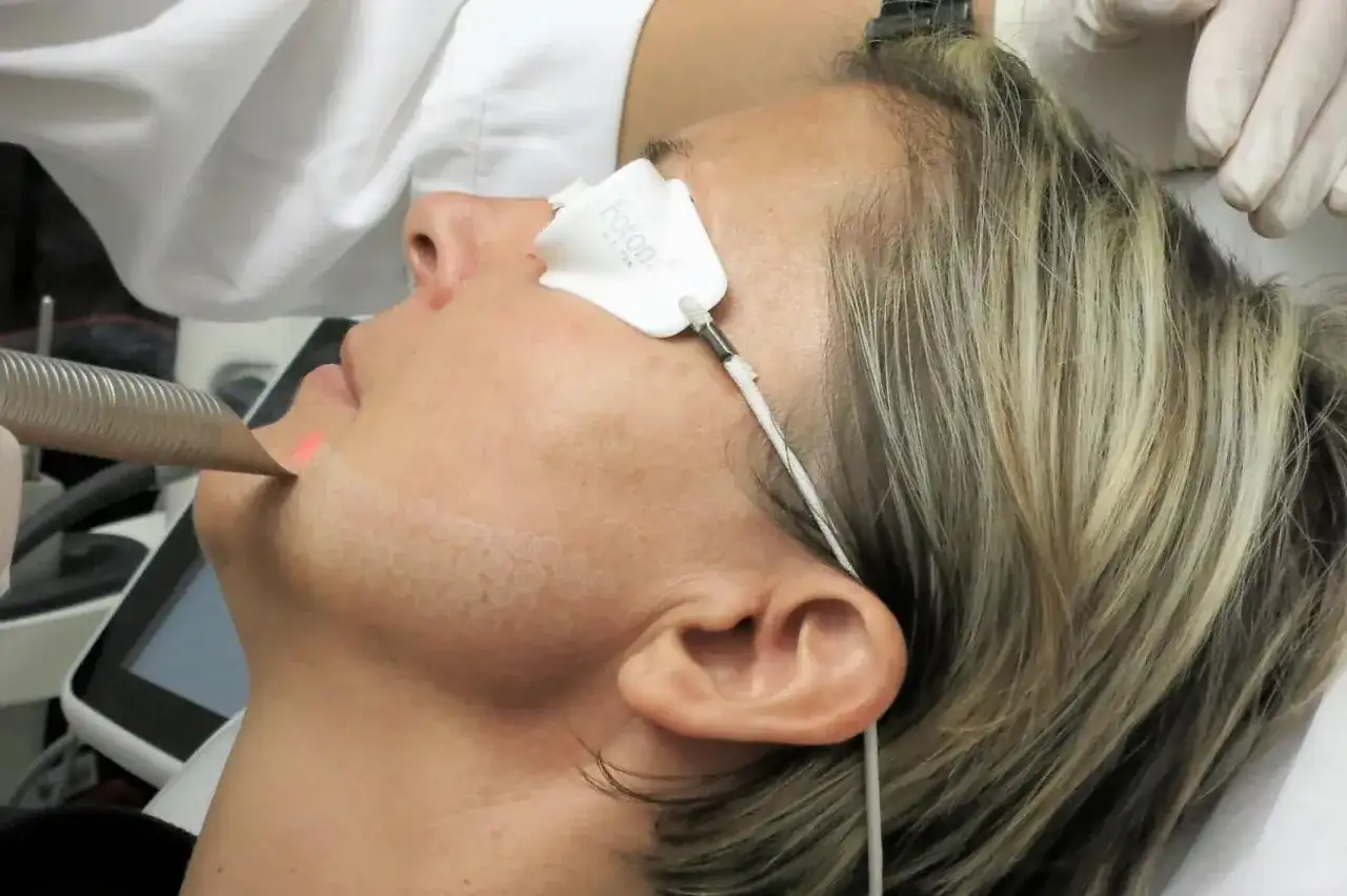 Endolifting twarzy - laser czy RF i czego się spodziewać?