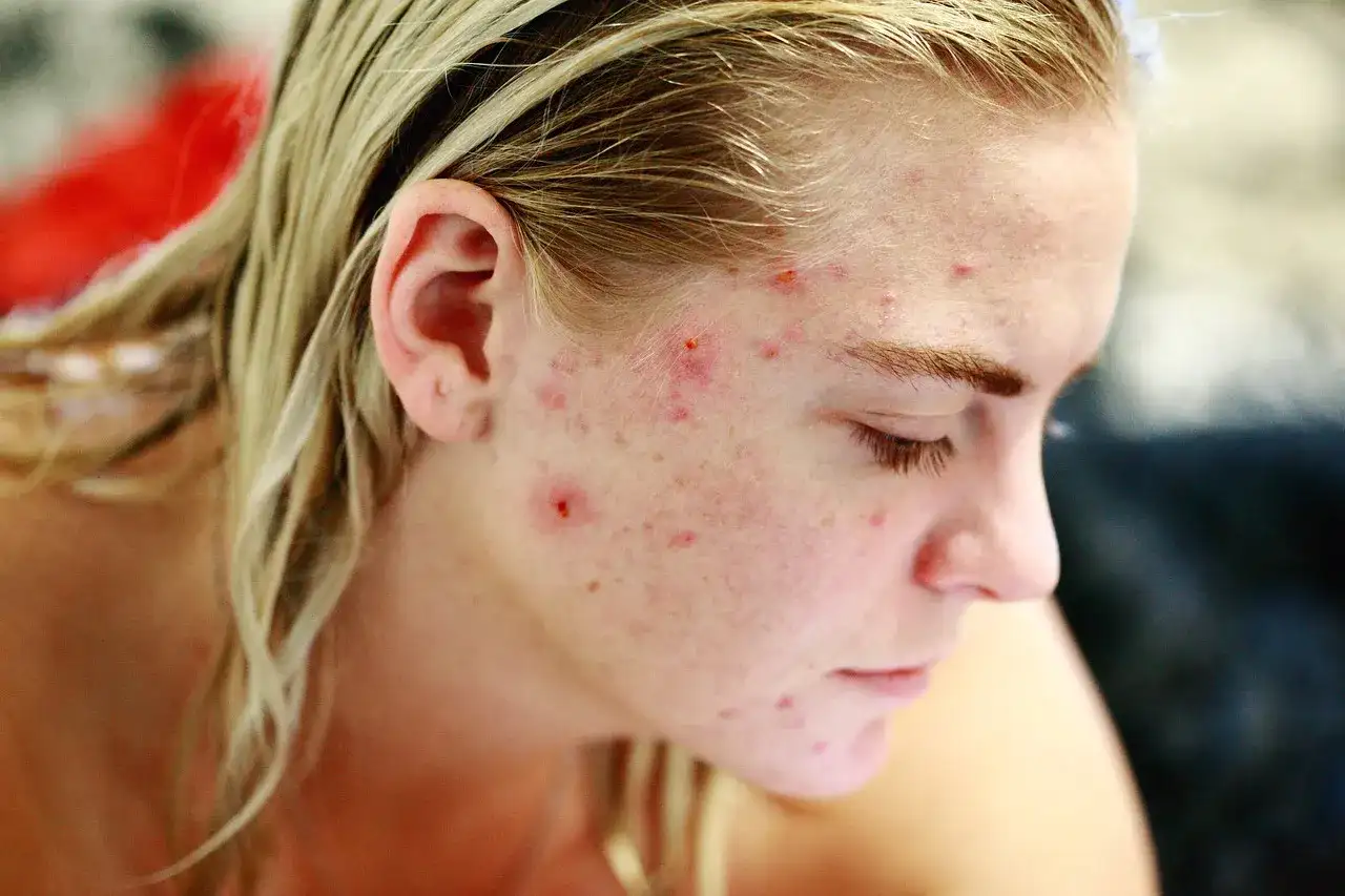 Bolesny pryszcz podskórny - co zrobić i kiedy iść do dermatologa?