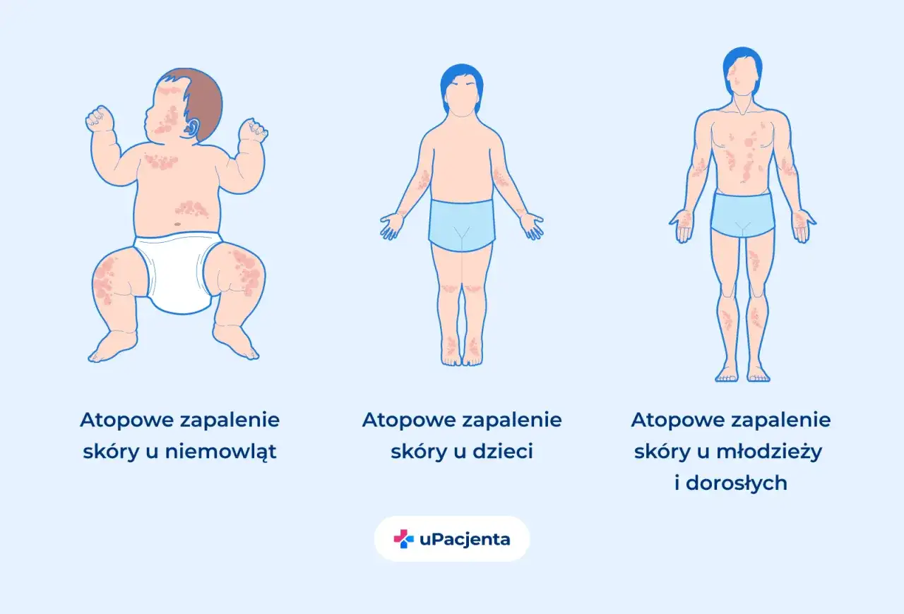 AZS i skóra atopowa - objawy, leczenie i pielęgnacja