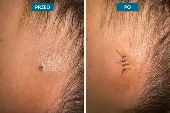 Zabiegi laserowe na skórę - rodzaje, efekty i ceny